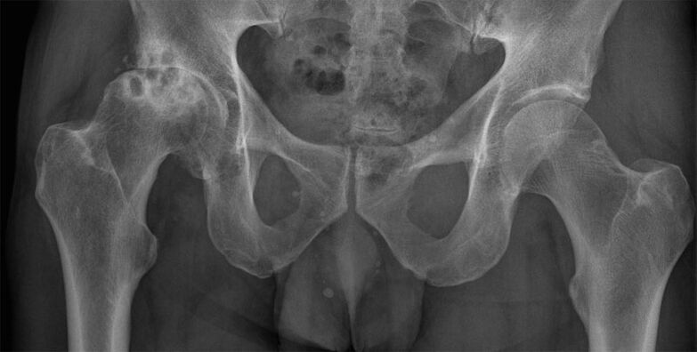 Stage 3 of hip joint arthrosis on x-ray