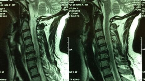 MRI of the cervical department