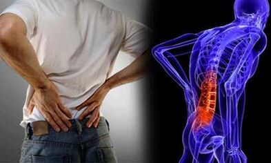 Reasons for developing lumbar osteochondrosis