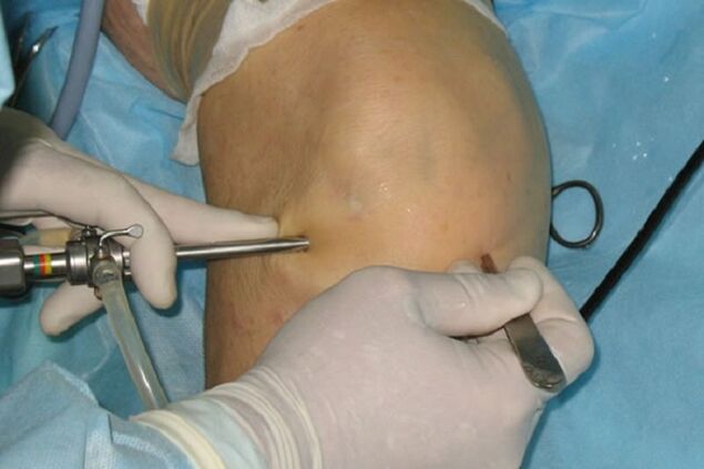 arthroscope for knee pain